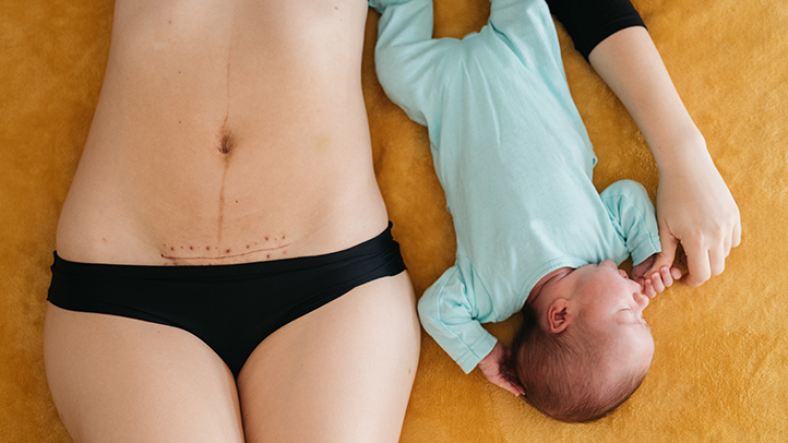 woman caring for a C-section scar