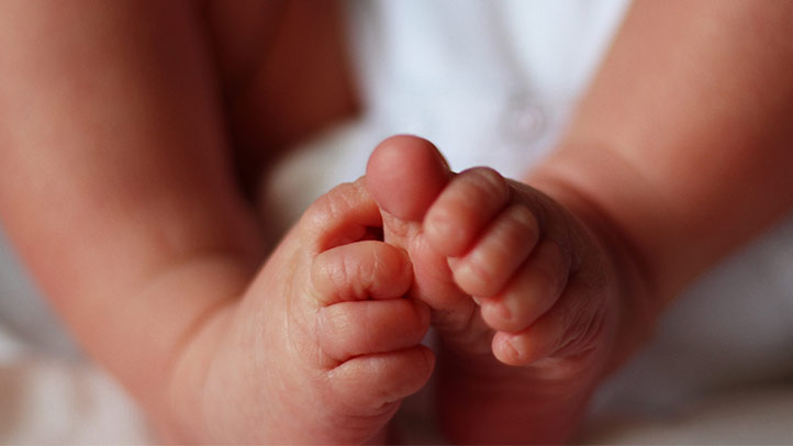 club foot in babies, feet of baby with club foot