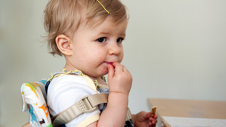 baby toddler with hand food and mouth disease coxsackie virus