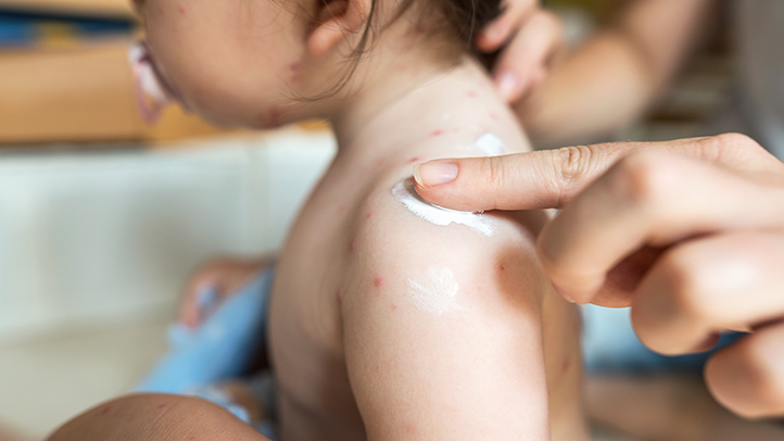 Skin rashes in babies and toddlers