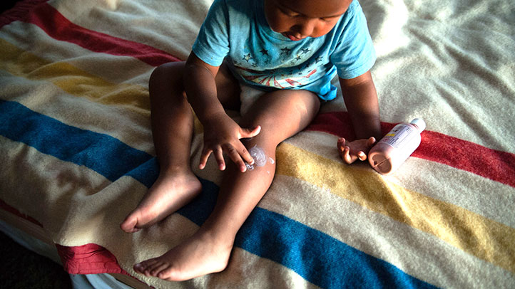 treating mosquito bites in children, little boy putting calomine lotion on a mosquito bite on his leg