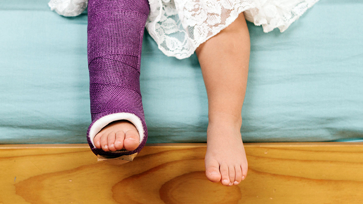 when your toddler fractures a bone, little girl with cast on leg